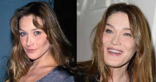 Carla bruni was born on december 23, 1967 in turin, piedmont, italy as carla gilberta bruni tedeschi. Carla Bruni Plastic Surgery Disasters Purple Clover