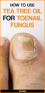 Tea Tree Oil To Treat Toenail Fungus How To Use Toenail Fungus Toe Nails Doterra Tea Tree Oil
