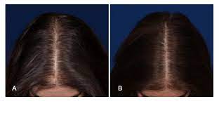If you want to lose weight then do not go on a crash diet as this can be a cause of female hair loss. Updates Cures For Hair Loss 2021 Follicle Thought