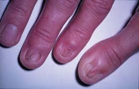 الباحثون السوريون الحزاز المسطح lichen planus تعر ف عليه أكثر