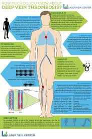 How Much Do You Know About Deep Vein Thrombosis Laser Vein Center Vein Thrombosis Deep Vein Thrombosis Thrombosis