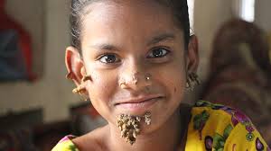 We did not find results for: Epidermodysplasia Verruciformis Symptoms Treatment And More