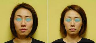 頬がげっそりこける原因 歯列矯正 頬 x脚