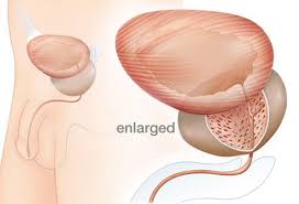 Slideshow A Visual Guide To Enlarged Prostate Bph Enlarged Prostate Prostate Prostate Surgery
