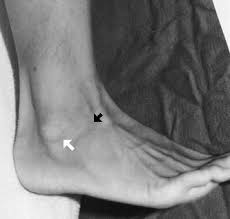 Pain is more during abduction of thig. Understanding Ankle Injuries