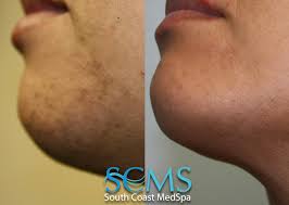 Laser hair removal for lip & chin. Laser Hair Removal Before And After Los Angeles San Diego
