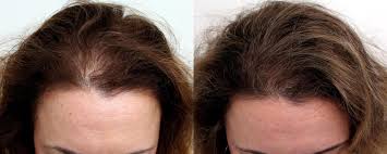 Finding the cause of your hair loss might take a lot of work. Female Hair Loss Manhattan Nyc True Dorin Medical Group Hair Restoration