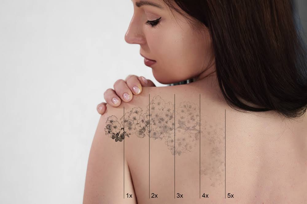 Laser Tattoo Removal product image