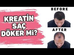 Kreatin Sac Doker Mi Sac Dokulmesi Sorunu Youtube