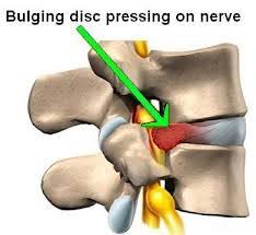Slipped disc can cause pain either around the damaged disc or anywhere along the area controlled by that nerve. Slipped Discs Chiropractors In Eastbourne