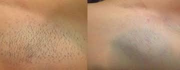 We did not find results for: Before And After Burn During Laser Hair Removal Laser Hair Laser Hair Removal Brazilian Laser Hair Removal