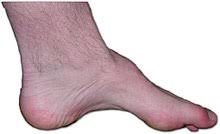 Maladie de charcot — sclérose latérale amyotrophique sclérose latérale amyotrophique classification et ressources externes cim 10 g12.2 cim 9 335.20 … Maladie De Charcot Marie Tooth Wikipedia