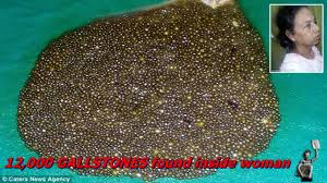 12 000 Gallstones Found Inside Woman Suffering Stomach Ache And Heartburn Youtube