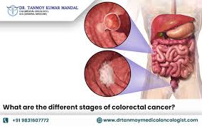 Image result for Colorectal Cancer