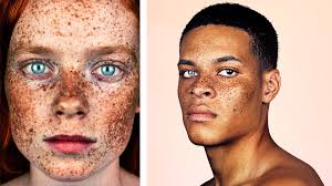 Image result for Freckles