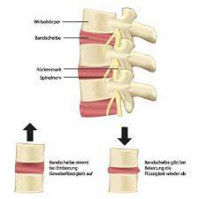 Spondylose Ursachen Symptome Behandlung Medlexi De