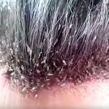Take the bag outside, and shake out the enclosed item. This Video Of A Man S Disgusting Head Lice Infestation Will Make Your Skin Crawl Mirror Online