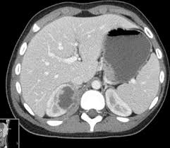 Image result for Perinephric Abscess