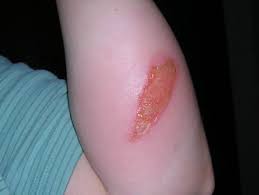 If your burn or scald has a blister that's burst, it may become infected if it's not kept clean. Burn Pictures First Second And Third Degree