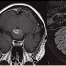 Metaanalysis for the evaluation of risk factors for carpal tunnel syndrome (cts) part ii. Pdf Neuropsychological Characteristic Of Cognitive Disorders In Patient With Clippers Syndrome