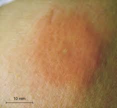 This usually subsides into itching, which can last for a few days. Insect Bite Identification Guide Flick Pest Control Solutions