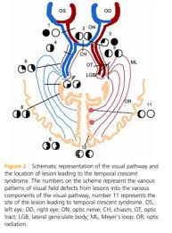 Image result for Visual Field Deficit