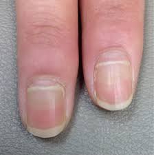 Image result for Beau lines feet