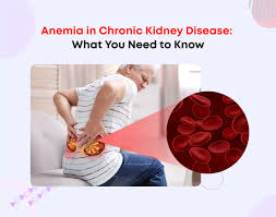 Image result for Anemia