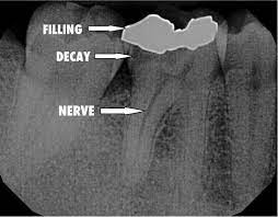 What Is A Root Canal Build Up And Crown Marc Vance Dmd Sensitive Teeth Root Canal Dental