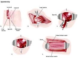 Low Cost Best Surgeons Top Hospitals For Affordable Laparoscopic Hernia Surgery In India