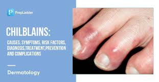 Image result for Chilblains
