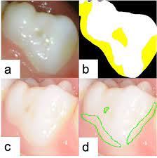 The images can be captured using lasers or digital scanners. Deep Learning Based Dental Plaque Detection On Primary Teeth A Comparison With Clinical Assessments Bmc Oral Health Full Text