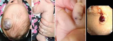 Blue Rubber Bleb Nevus Syndrome Springerlink