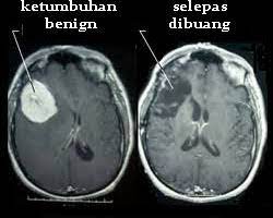Sakit kepala, mual, muntah, kejang, perubahan visi. Kenali 5 Tanda Ketumbuhan Otak Yang Paling Kerap Berlaku Benign Meningioma Iluminasi