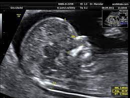 The nuchal translucency scan (also called the nt scan) uses ultrasound to assess your developing baby's risk of having down syndrome (ds) and some other chromosomal abnormalities, as well as major congenital heart problems. Nuchal Scan Wikipedia