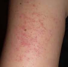 Ils sont généralement de couleur brunâtre, bien que certains puissent être plus repérez les grains de beauté qui grandissent et ceux d'une taille supérieure à 5 mm de diamètre. Bouton Rouge Qui Gratte Demangeaisons Et Bouton De Peau