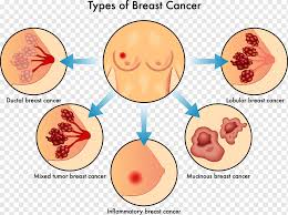 The inflammatory breast cancer research foundation wishes to thank these patients for sharing their photos with the ibc community. Inflammatory Breast Cancer Invasive Lobular Carcinoma Women Chest Cancer Types Analyzed Food Holidays Women Accessories Png Pngwing