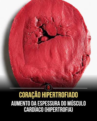 Coração Hipertrofiado: Causas, Sintomas e Tratamentos Essenciais