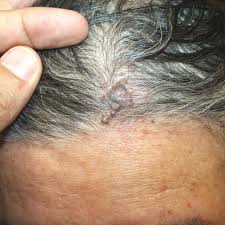 Early detection melanoma can be tricky. Current Management Of Malignant Melanoma State Of The Art Intechopen
