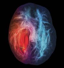 A Malignant Brain Tumor Red Mass Left In This Person S Brain Is Wreathed By Fine Tracts Of White Matter The Red Fibers Signal Science Images Tumor Science