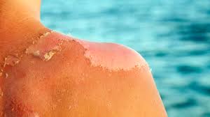 Image result for Sunburn