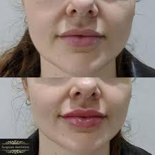 When doctors and aesthetics become partners, you just know you're onto a good thing, . Lip Fillers Barnet Marylebone London Surgicare Aesthetics