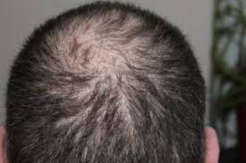 Therefore, in order to generate new hair follicles, we need to break down the scar tissue and generate new, healthy, unscarred tissue. How To Regrow Hair On Bald Head Fast Natural Formulas Public Health