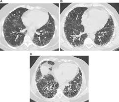 Asbestosis was defined by the following pulmonary interstitial. Scielo Brasil Imaging In Idiopathic Pulmonary Fibrosis Diagnosis And Mimics Imaging In Idiopathic Pulmonary Fibrosis Diagnosis And Mimics