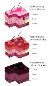 Verbrennung Medizin Wikipedia