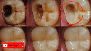 Membersihkan gigi dengan benang masih menjadi cara yang paling efektif untuk menghilangkan makanan dan plak di penyakit gusi yang tidak dikendalikan dapat merusak jaringan dan tulang rawan di dalam mulut anda. Petua Hilangkan Sakit Gigi Digital Mukmin