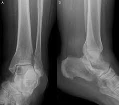 Bone cancer can begin in any bone in the body, but it most commonly affects the pelvis or the long bones in the arms and legs. Erosive Breast Cancer Metastasis To The Ankle A Case Report The Journal Of Foot And Ankle Surgery