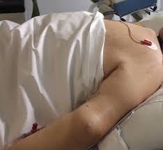 Pruning is a horticultural and silvicultural practice involving the selective removal of certain parts of a plant, such as branches, buds, or roots. Does Proning On Niv Improve Oxygenation Bmj Case Reports