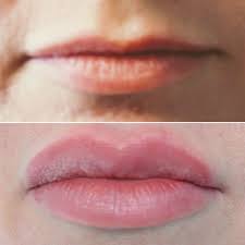 Maybe you would like to learn more about one of these? Lips Using 1 Syringe Of Juvederm Ultra Love These Results Mcosmeticsurgery Lip Fillers Peeling Skin Natural Skin Tightening