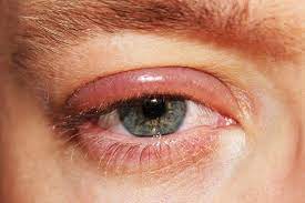 Blepharitis Eyelid Inflammation Causes Symptoms Remedies Blepharitis Tea Tree Oil Natural Rosacea Treatment